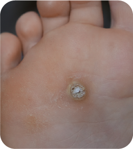 Verruca & wart